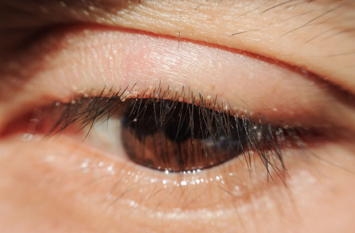 Blefarit - Ögonlocksinflammation